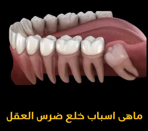 ماهى اسباب خلع ضرس العقل 